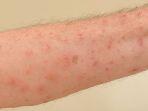 scabies-5.jpg