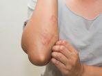 scabies-6.jpg