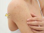 scabies-7.jpg