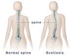 skoliosis-2.jpg
