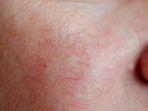 spider-vein-1.jpg