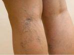 spider-vein.jpg