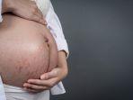 stretch-mark-8.jpg