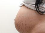 stretch-mark-9.jpg