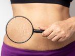 stretchmark-2.jpg