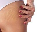 stretchmark-3.jpg