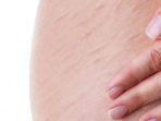 stretchmark-5.jpg