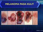tampilan-tahi-lalat-tanda-melanoma.jpg