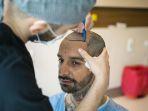 transplantasi-rambut-1.jpg