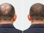 transplantasi-rambut-3.jpg