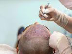 transplantasi-rambut.jpg