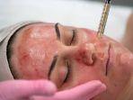 treatment-prp-3.jpg