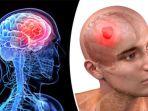 tumor-otak.jpg