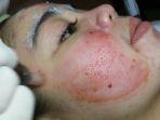 vampire-facial-4.jpg