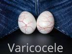 varikokel-6.jpg