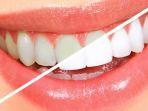 veneer-gigi-1.jpg