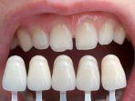 veneer-gigi-10.jpg
