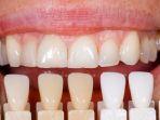 veneer-gigi-12.jpg