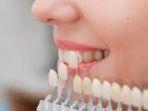 veneer-gigi-15.jpg