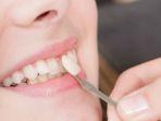 veneer-gigi-16.jpg