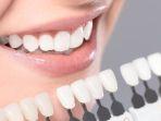 veneer-gigi-18.jpg