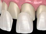 veneer-gigi-3.jpg