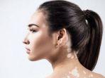 vitiligo1.jpg