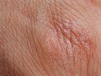 xerosis-cutis-1.jpg