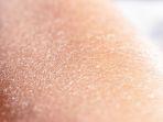 xerosis-cutis-2.jpg