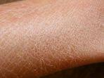 xerosis-cutis-3.jpg