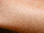 xerosis-cutis.jpg