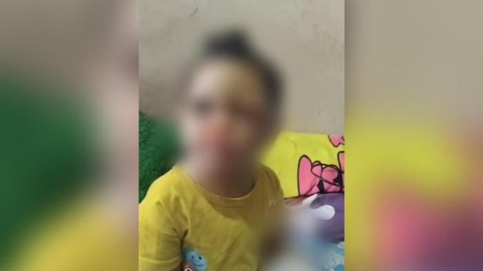 BALITA KORBAN ANIAYA - SA (2) mengalami kekerasan fisik hingga retak tulang dan luka serius di wajah, ia merupakan warga rumah susun Kelurahan Margawati, Kecamatan Garut Kota, Kabupaten Garut, Jawa Barat.