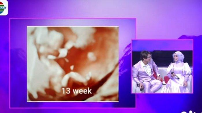 Rizky Billar Akan Jadi Ayah, Lesti Diprediksi Lahiran Januari 2022, Ini Pengakuan Sang Dokter
