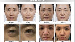 Re-LIFT-Kulit-Kencang-Tanpa-Ribet-Pakai-Teknologi-Canggih-HIFU-Di-Klinik-Utama-Lineation-1.jpg