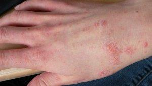 ilustrasi-penyakit-kulit-kudis-atau-scabies.jpg