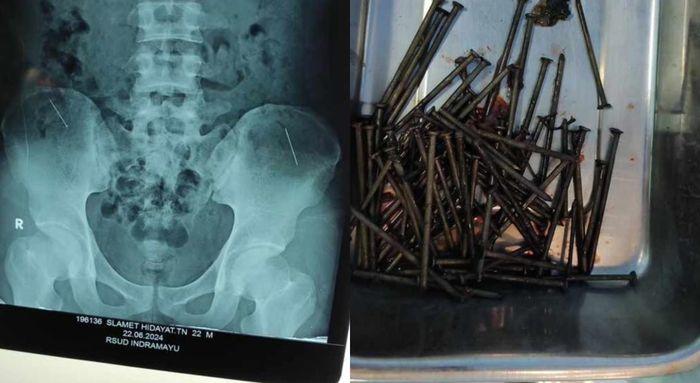 Hasil-rontgen-dan-paku-paku-RSUD-Indramayu.jpg
