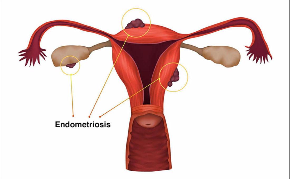 Mengapa Wanita dengan Endometriosis Kesulitan Punya Anak? Ini Penjelasan Dokter Spesialis Obstetri