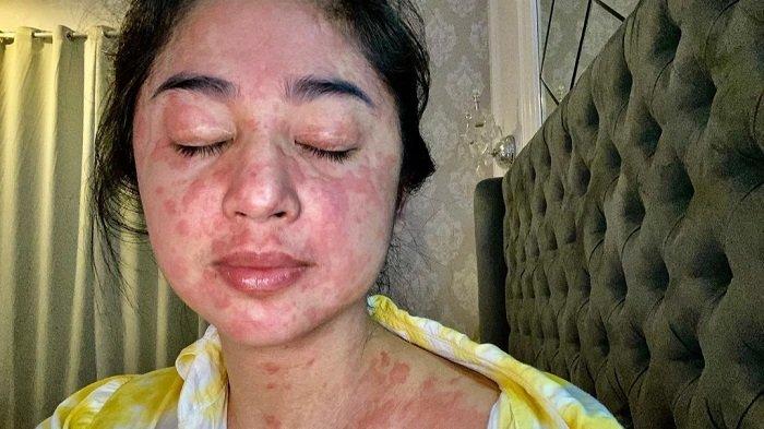 kondisi-kulit-dewi-perssik-saat-terpapar-covid-19-dia-kini-sudah-dinyatakan-sembuh.jpg