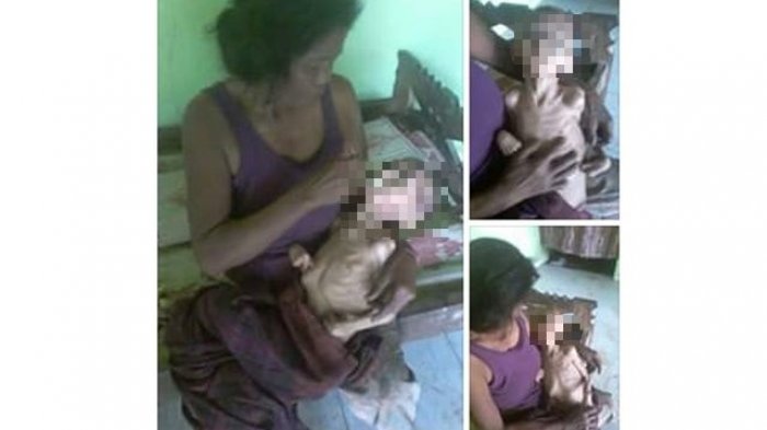 Derita Nurwati, Sudah 14 Tahun tapi Beratnya Seperti Bayi Umur Setahun