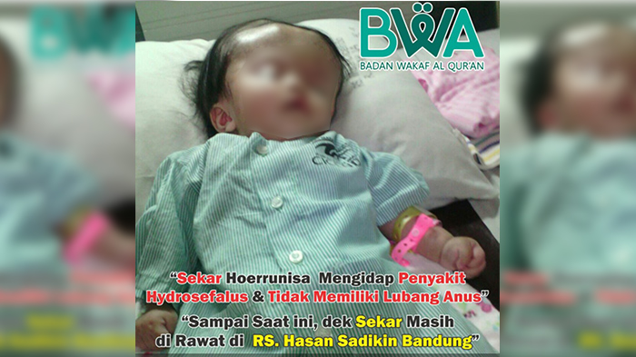 Sekar Hoerunnisa, Bayi Penderita Hidrosefalus dan Lahir Tanpa Lubang Anus, Makan pun Pakai Selang