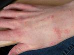 ilustrasi-penyakit-kulit-kudis-atau-scabies.jpg