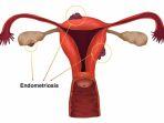 ilustrasi-rahim-ilustrasi-endometriosis.jpg