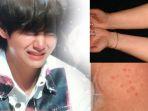 v-bts-menderita-cholirgenic-urticaria.jpg