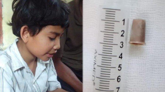 Peluit Sempat Bersarang di Paru-paru hingga Napas Bunyi Terompet, Begini Kondisi Asep Yaya Sekarang