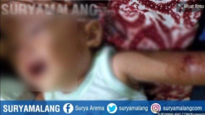 Bayi 13 Bulan Alami Nasib Malang saat Disuapi Makan Ibu, Lengan Kirinya Tertembak Peluru