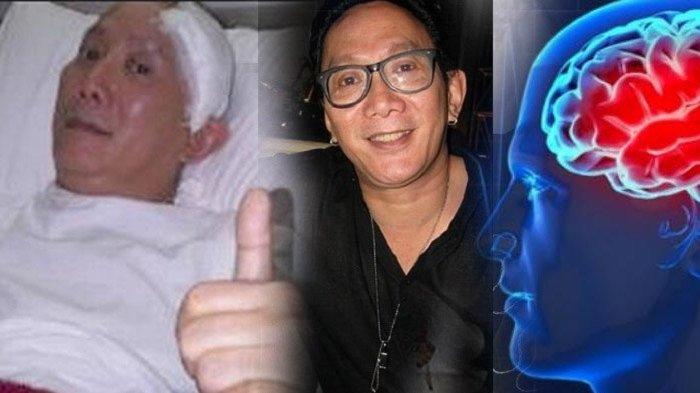 Sebelum Meninggal Aktor Robby Tumewu Idap Stroke, Yuk Kenali Gejala dan Cara Pencegahannya