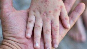 Ilustrasi-penyakit-Mpox.jpg