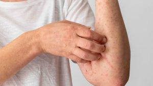 Saat-muncul-beberapa-gejala-Mpox.jpg