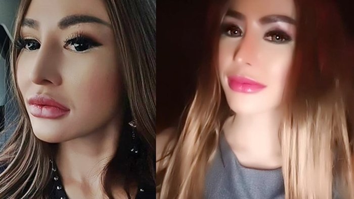 Lakukan Filler Bibir, Penampilan Artis Ini Hampir Tak Dikenali dan Tuai Cibiran Netter