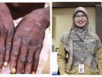 Cacar-Monyet-dan-Kepala-Dinas-Kesehatan-Kota-Depok-dr-Mary-Liziawati.jpg
